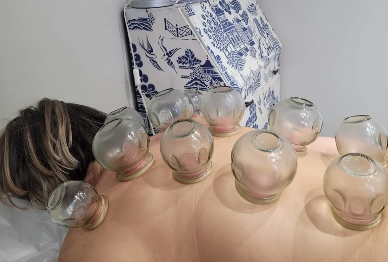 Cupping 1 768x520